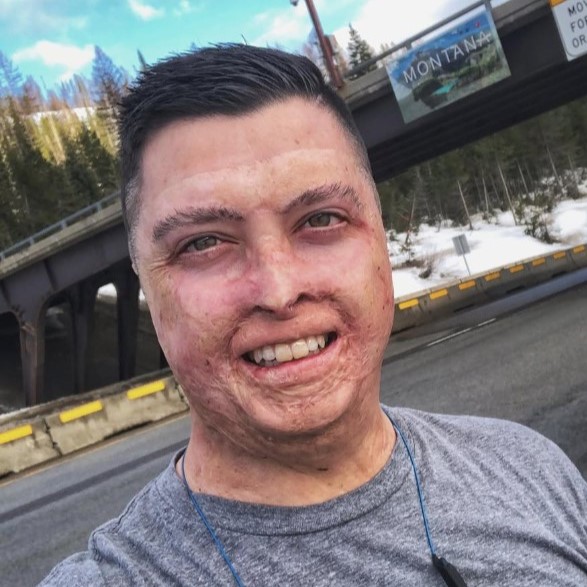 Daniel Lyon, Burn Survivor Daniel Lyon, Burn Survivor